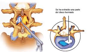 DISCECTOMIA en hernia discal